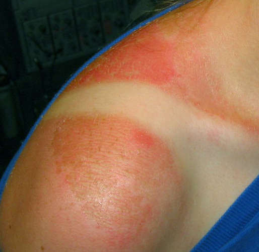 heat rash on babies pictures. aby heat rash pictures. heat